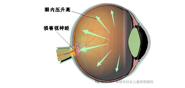 重視青光眼，防止視功能損傷