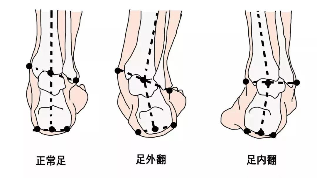 為什么寶寶雙腳鞋底磨損不一樣？可能是足外翻！