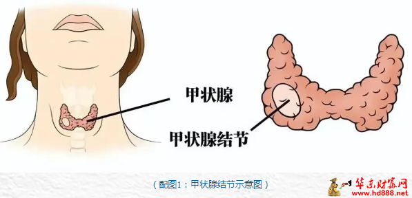 老年患者高難度甲狀腺癌手術(shù)成功！