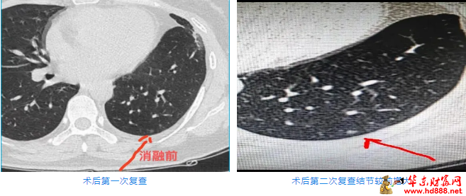 被“凍死”的結(jié)節(jié)：低溫冷凍，高效消瘤，肺結(jié)節(jié)患者健康的新選擇！